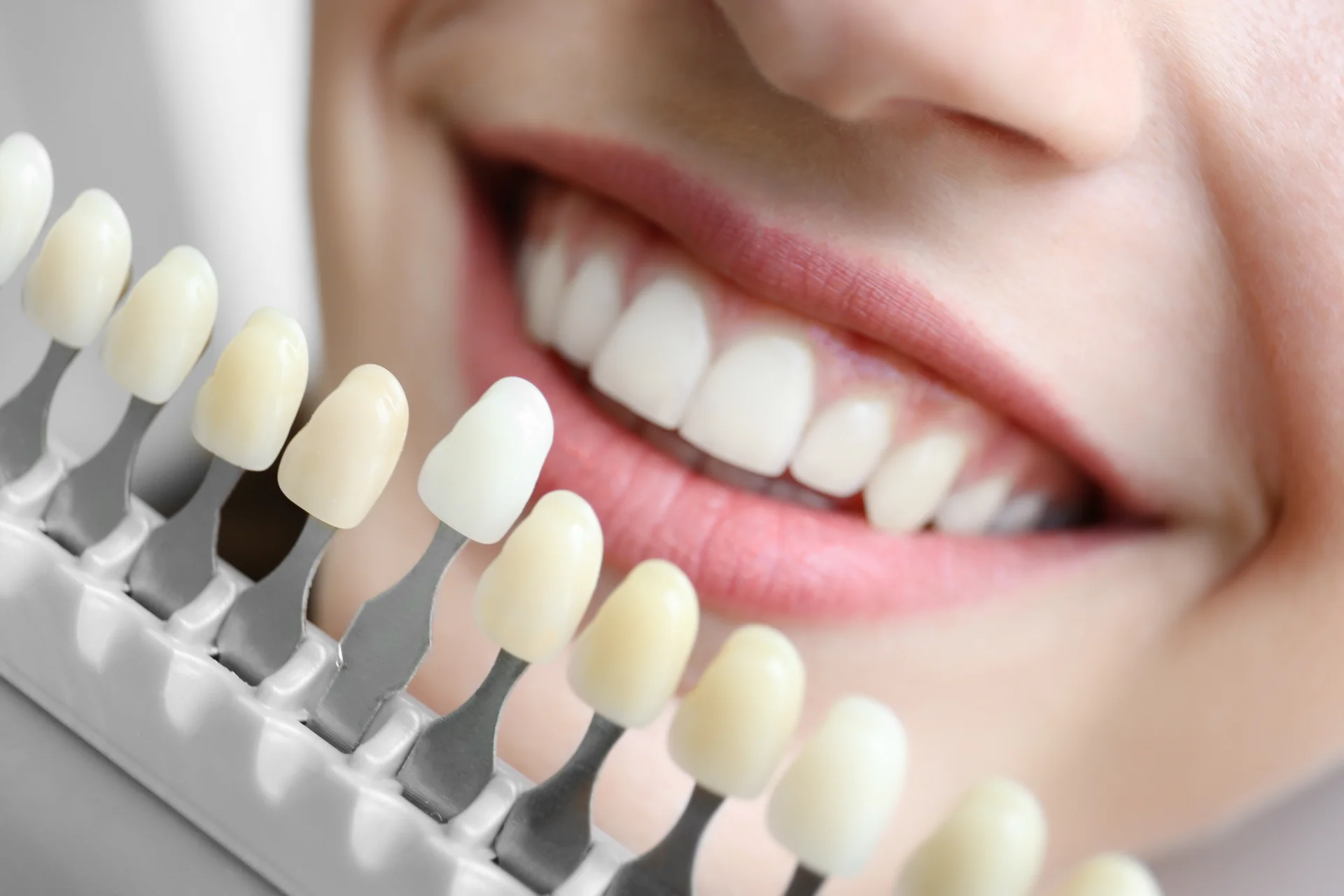 Detail of teeth showing shade and shape refinement
