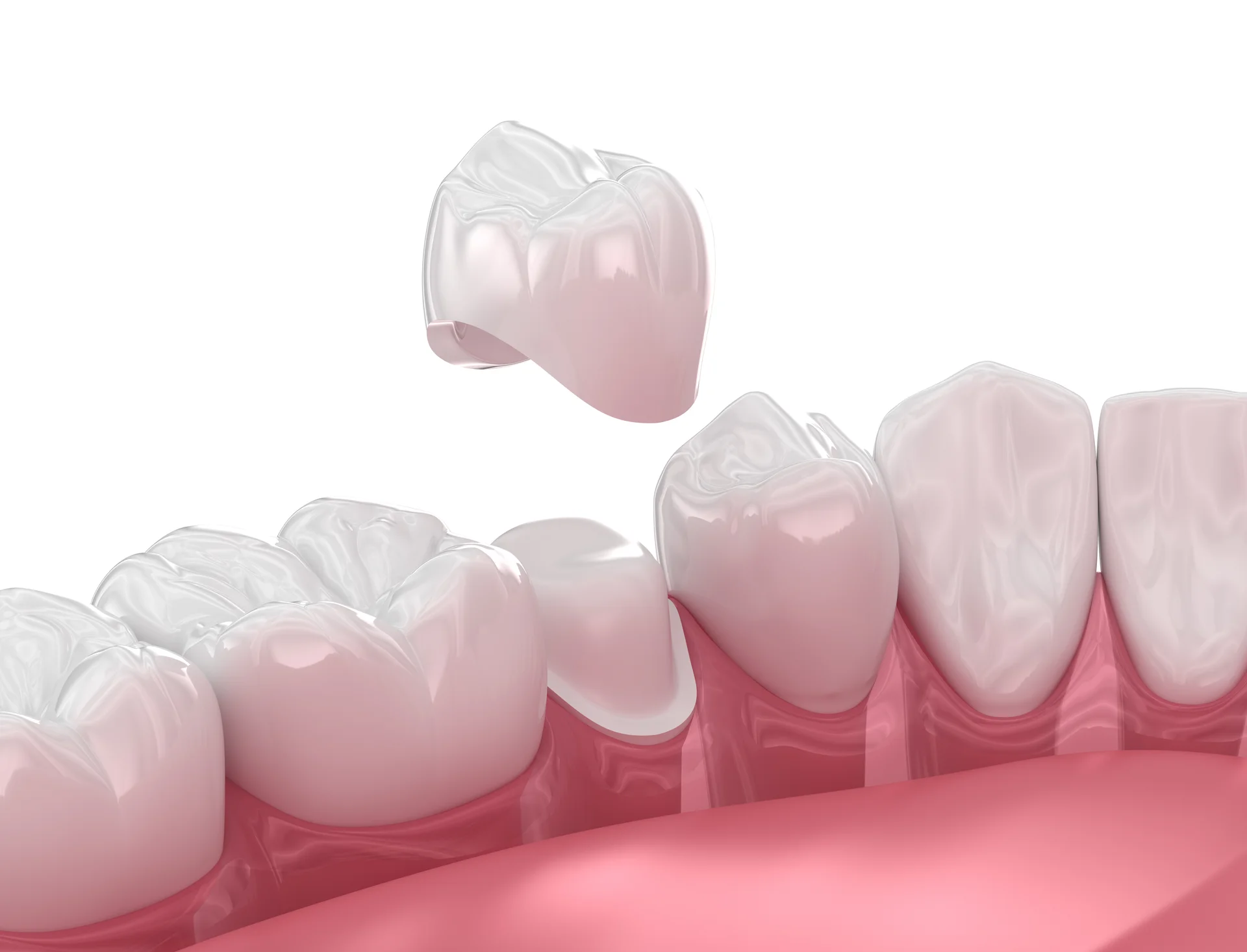Ceramic dental crown being placed over a prepared tooth