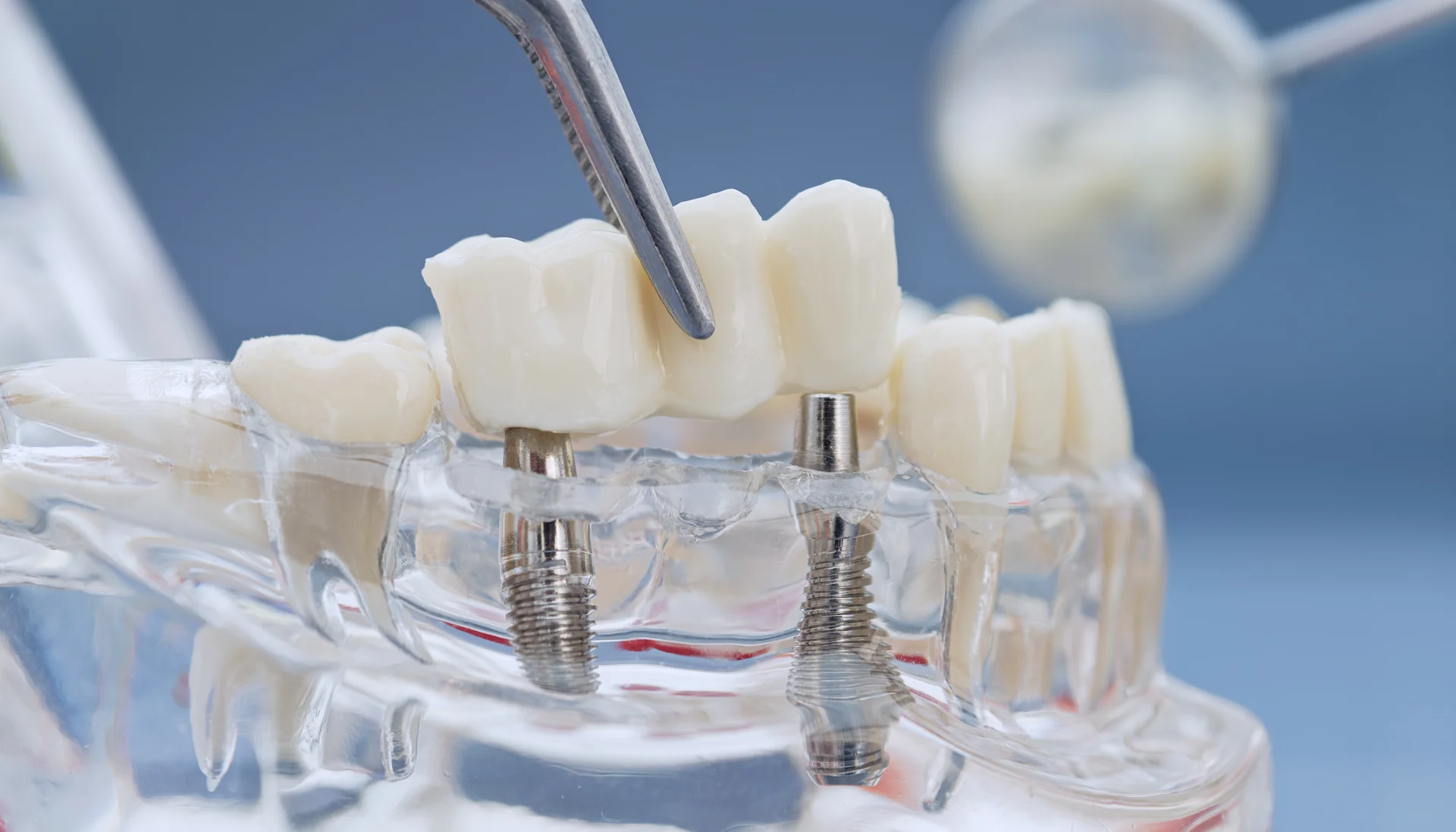 Complex crown and bridge work spanning multiple teeth