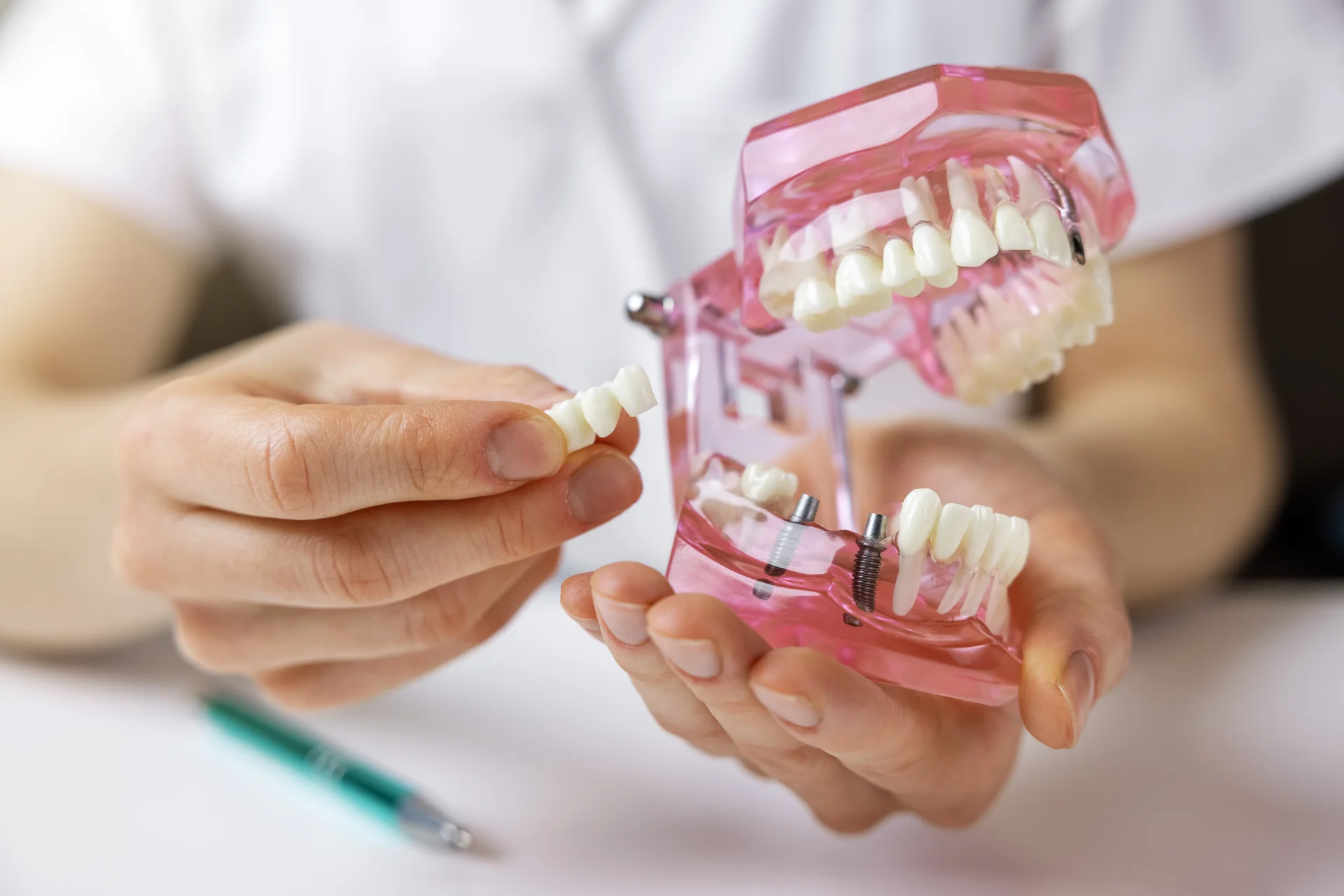 Treatment planning for implant-supported dentures and full-arch restoration