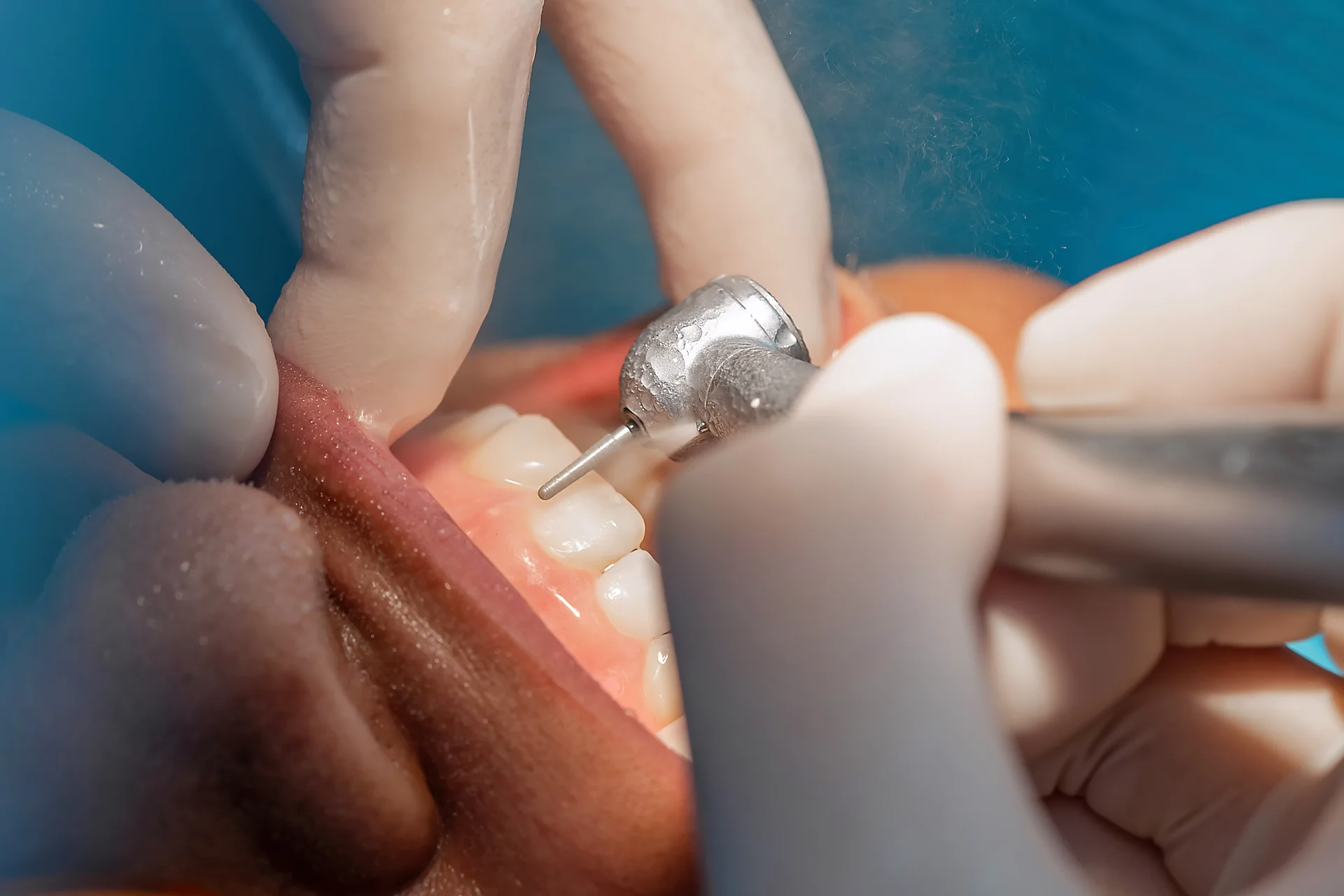 Close-up of precise restorative dental work on a tooth